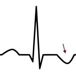 ECG pédicardite onde T négative