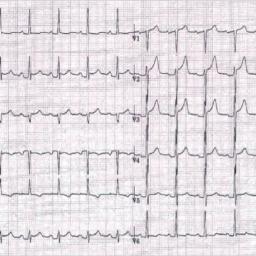 ECG péricardite 2