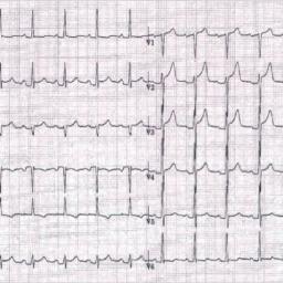 ECG péricardite 2