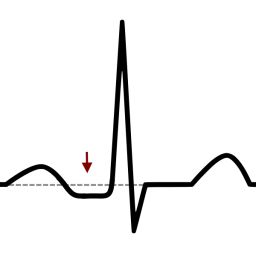 ECG péricardite sous-décalage PR