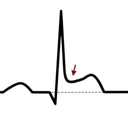 ECG Péricardite sus-décalage ST