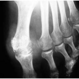 Arthropathie uratique MTP