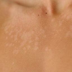 Pityriasis versicolor sur peau bronzée