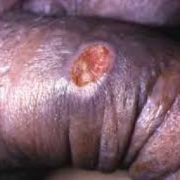 Chancre syphilis