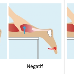 Test de compression du mollet [Test de Thompson]